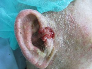 גידול סרטני באוזן - לאחר הסרת הגידול ושחזור